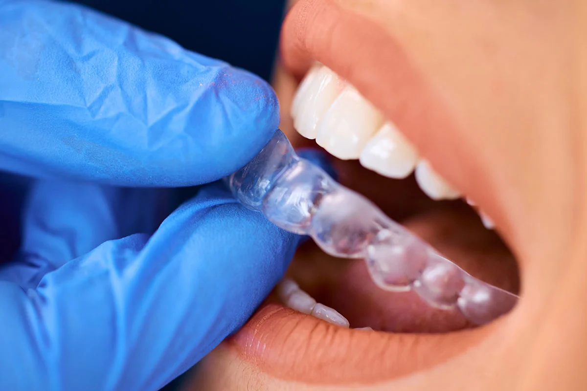 aparat dentar invizibil