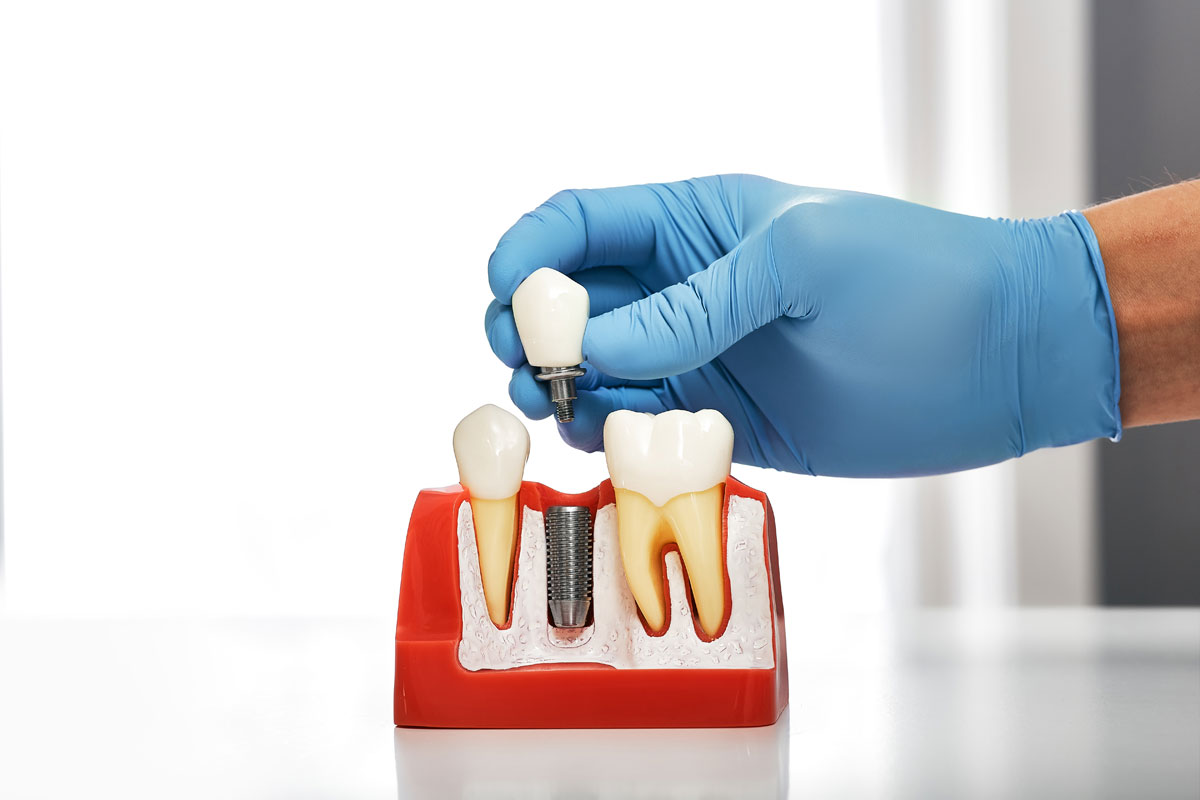 Stomatolog care arata instalarea unui implant dentar pe modelul anatomic al dintilor