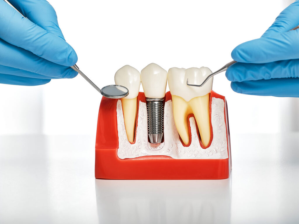 implantul dentar