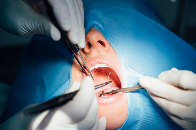 timpul de vindecare dupa implantul dentar