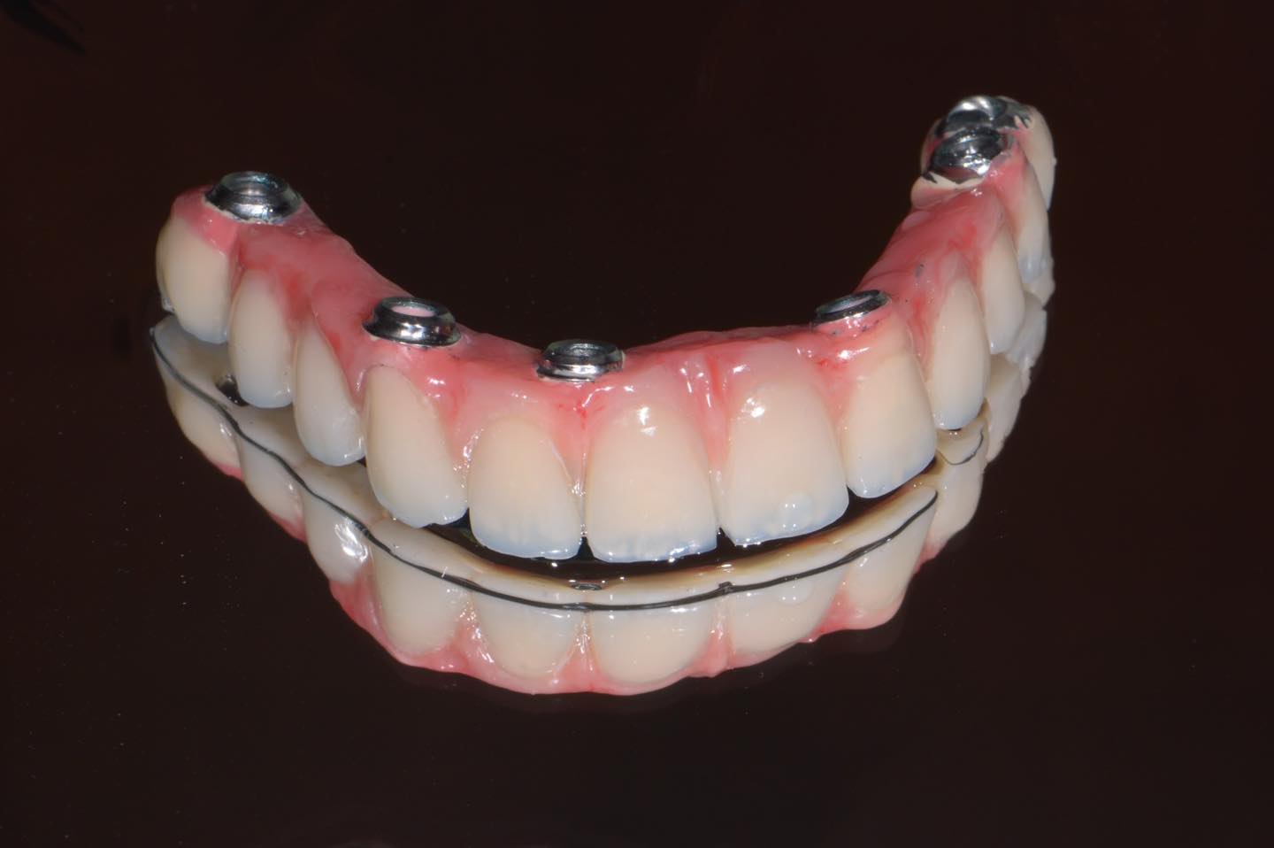 Candidatul ideal pentru procedurile All on 4 și All on 6